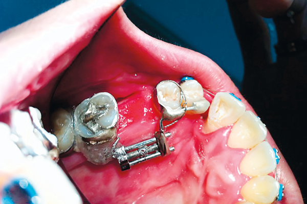 Distração osteogênica segmentar no tratamento interdisciplinar da fissura dentoalveolar