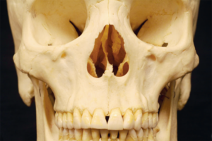 Maturação das suturas faciais em tomografias de feixe cônico na predição da expansão rápida e protração maxilar