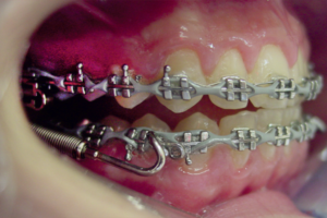 Efeitos dentoesqueléticos e tegumentares induzidos pelo aparelho Forsus em pacientes Classe II