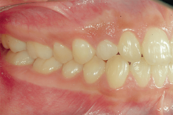 Utilização da biomecânica racional no tracionamento de caninos superiores