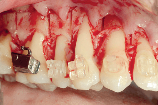 Corticotomia visando à aceleração do tratamento ortodôntico