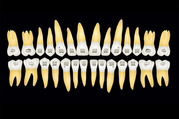 Adesão – o que o ortodontista precisa saber?
