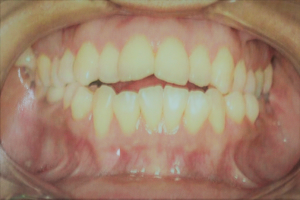 Tratamento de mordida aberta anterior por meio de exodontias de primeiros molares permanentes – preservação de dez anos de caso clínico