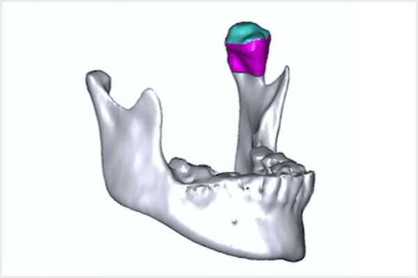 A importância da avaliação volumétrica condilar na Ortodontia e na cirurgia ortognática