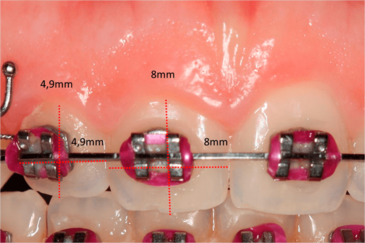 Discrepância de tamanho dentário: a importância do diagnóstico