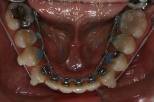 Ortodontia lingual e mini-implantes extra-alveolares