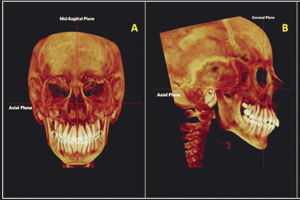 Efeitos da expansão rápida da maxila na área e no volume aéreo nasal em respiradores orais: estudo-piloto