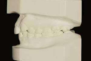 Interferência do ângulo nasolabial no tratamento com exodontia de pré-molares