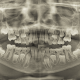 Abordagem interceptativa em primeiros molares superiores permanentes com erupção ectópica