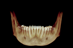 Comparação das dimensões do arco dental e basal mandibular em pacientes portadores de má-oclusão Classe I e Classe II utilizando TCFC e modelos digitais