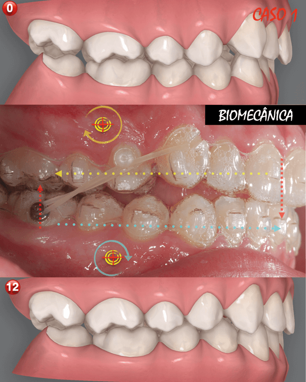 Alinhadores Na Correção Da Classe II: Elásticos Intermaxilares Ou Mini ...