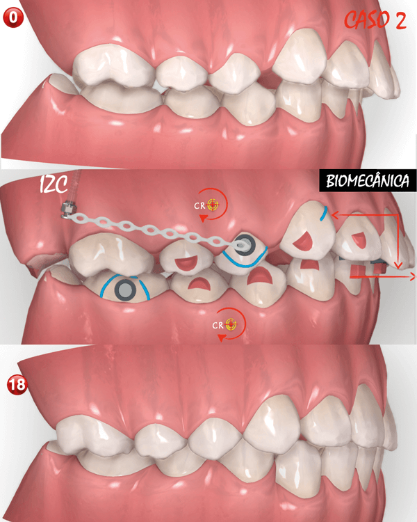 Alinhadores Na Correção Da Classe II: Elásticos Intermaxilares Ou Mini ...